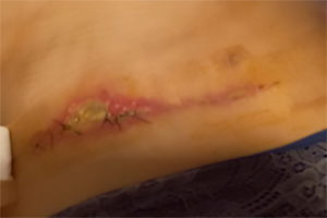 Deiscência de sutura